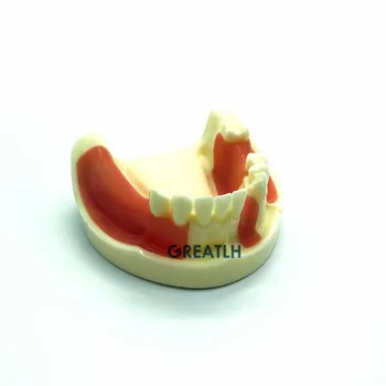 Dantų Implantai Praktikos modelio Apatinio Žandikaulio modelį su trūkstamus dantis pjovimo ir siuvimo Typodont Dantų Modelį su Gingiva